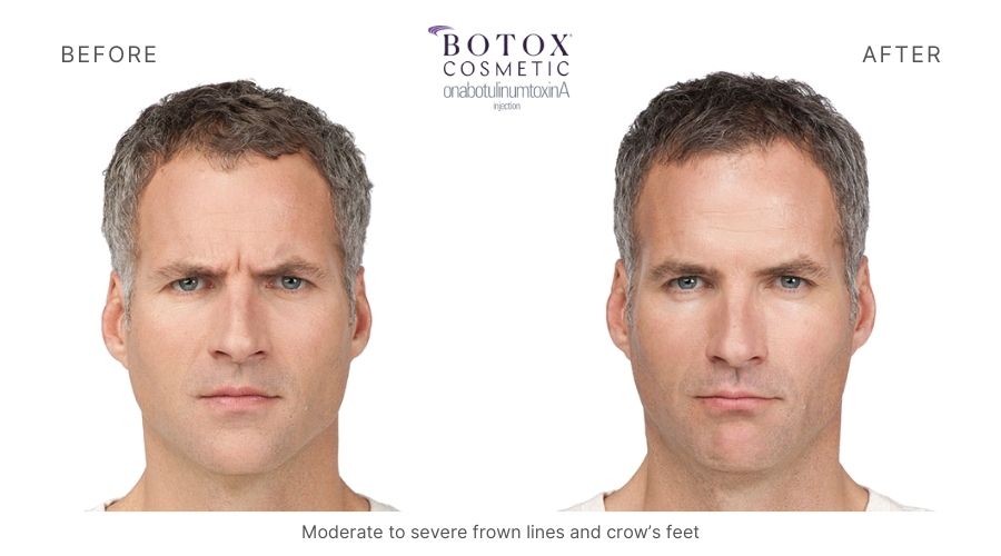 Before and after photos showing the results of Botox treatment at Mykonos Medspa in Sherman Oaks,