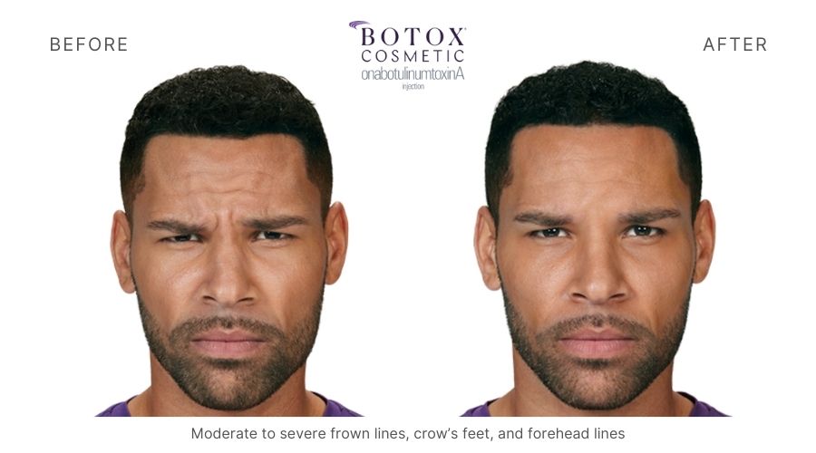 Before and after photos of Botox treatment at Mykonos Medspa, Sherman Oaks, showing removal of forehead wrinkles.