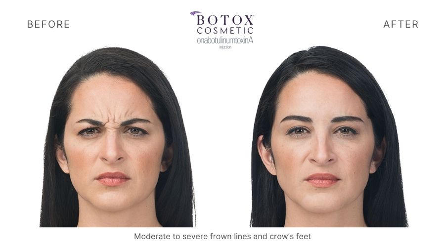 Botox Mykonos Medspa Sherman Oaks CA before and after botox 4