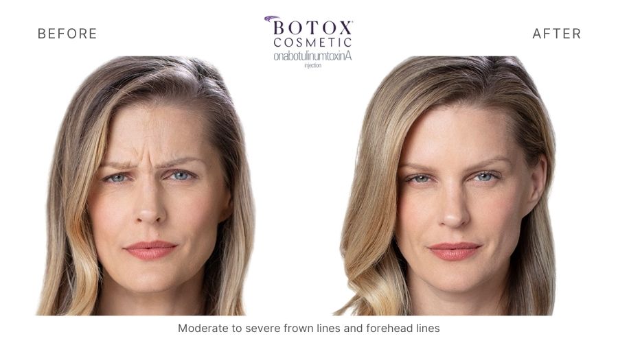 Botox Mykonos Medspa Sherman Oaks CA before and after botox 5