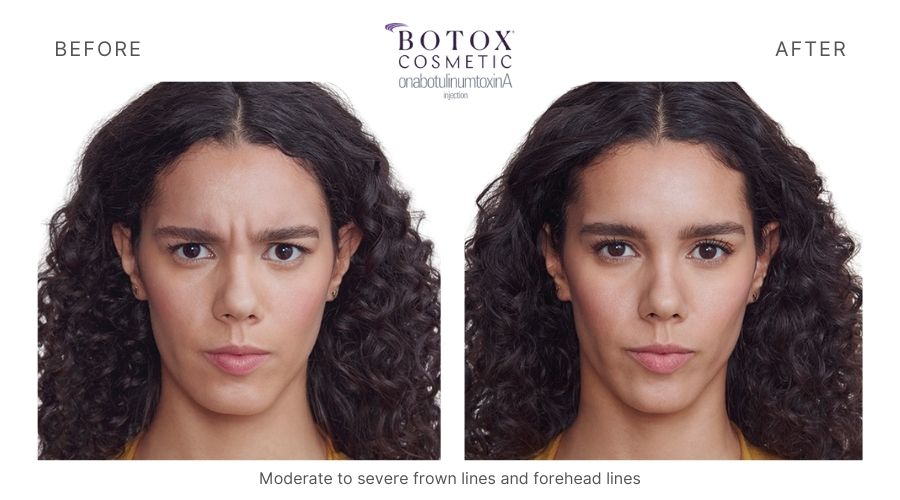Botox Mykonos Medspa Sherman Oaks CA before and after botox 6