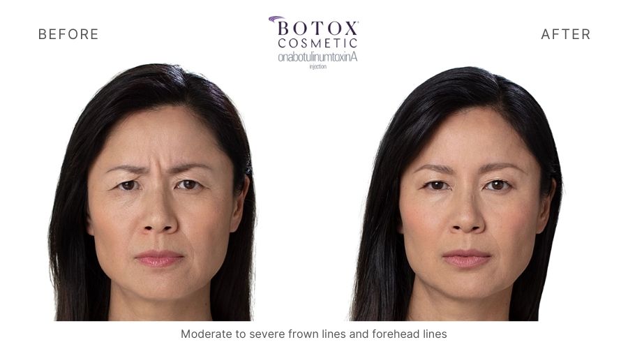 Botox Mykonos Medspa Sherman Oaks CA before and after