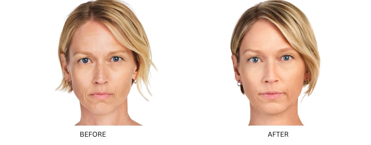 Dermal Fillers 13 Before and after result of women after getting botox from Mykonos Medspa in Sherman Oaks