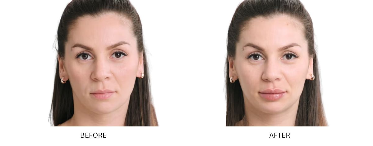 Dermal Fillers 14 Women showing before and after result of getting botox treatment from Mykonos Medspa in Sherman Oaks