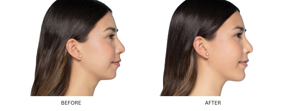Dermal Fillers 15 Dermal Filler Mykonos Medspa Sherman Oaks CA BA 4
