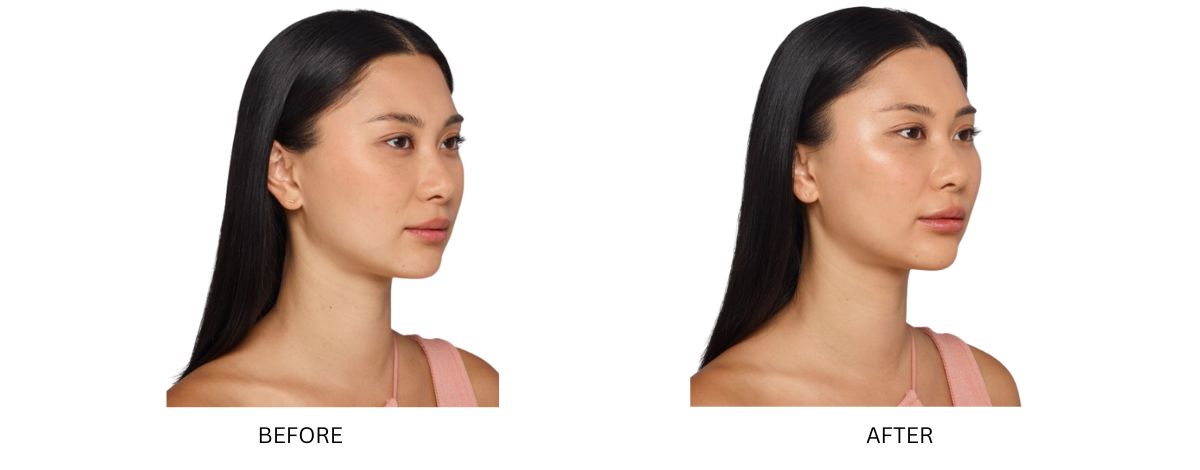 Dermal Fillers 16 Dermal Filler Mykonos Medspa Sherman Oaks CA BA 5