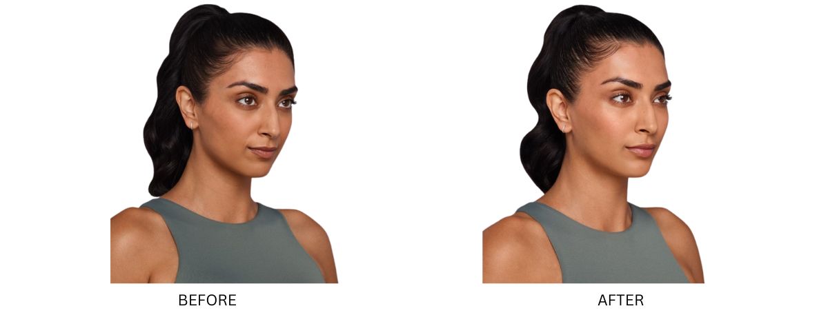 Dermal Fillers 18 Dermal Filler Mykonos Medspa Sherman Oaks CA BA 7