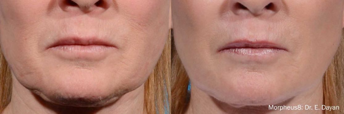 An image of before and after Laser Morpheus8 treatment.