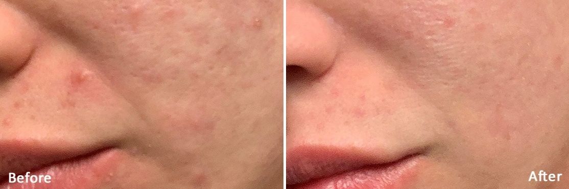 An image of before and after Laser Morpheus8 treatment.