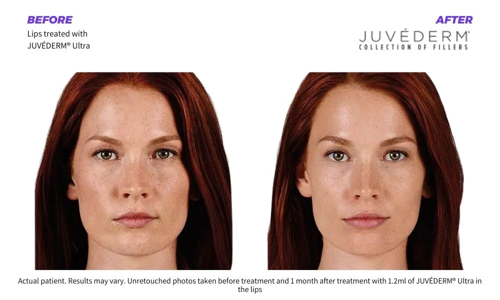 Mykonos Medspa juvederm fillers before and after 1
