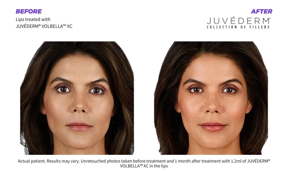 Mykonos Medspa juvederm fillers before and after