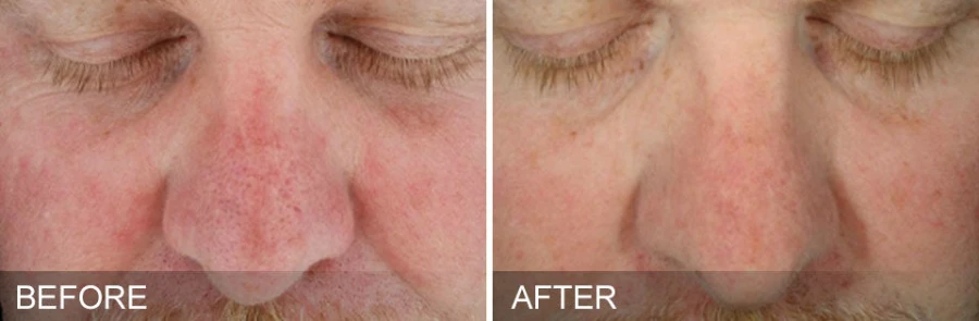 Hydrafacial Mykonos Medspa Sherman Oaks CA before and after 01