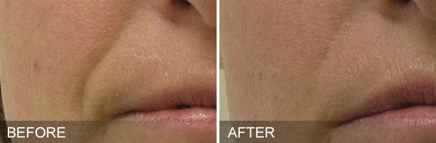 Hydrafacial Mykonos Medspa Sherman Oaks CA before and after 02