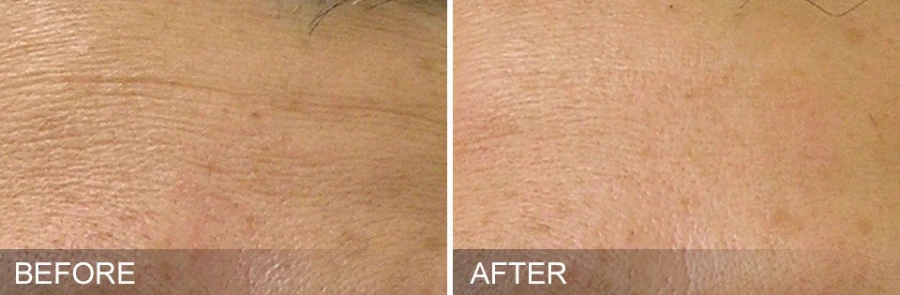 Hydrafacial Mykonos Medspa Sherman Oaks CA before and after 03