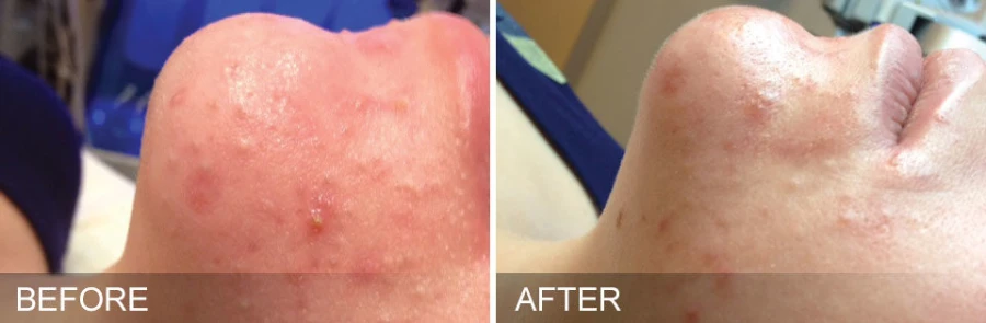Hydrafacial Mykonos Medspa Sherman Oaks CA before and after 04