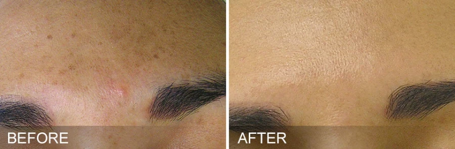 Hydrafacial Mykonos Medspa Sherman Oaks CA before and after 05